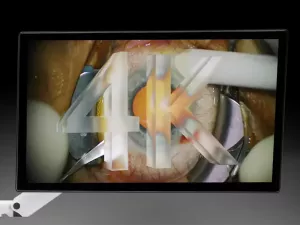 METIS 900 Нова офтальмологічна мікроскопічна система2_результат